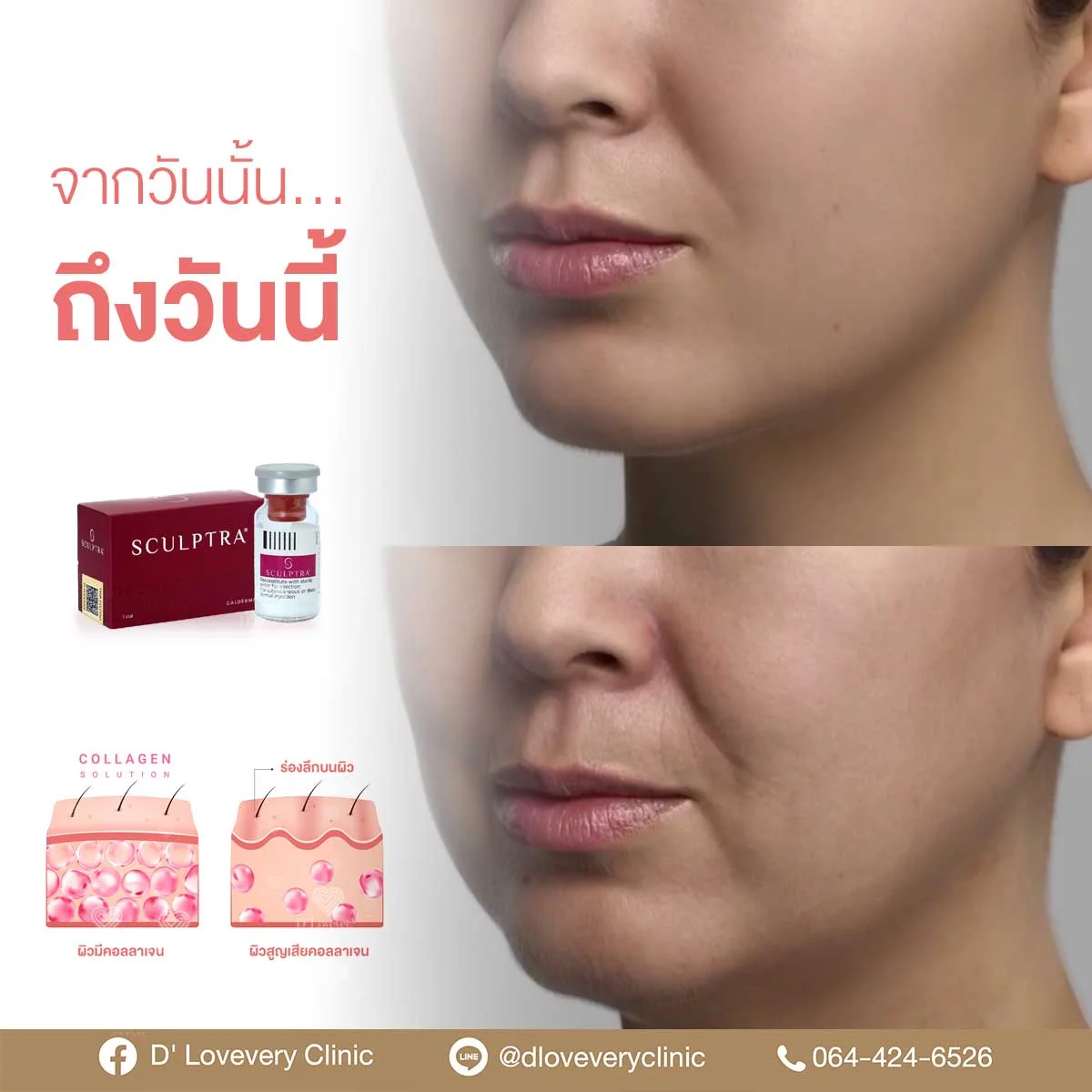Tiêm Sculptra bao lâu có kết quả với từng mục tiêu thẩm mỹ cụ thể?