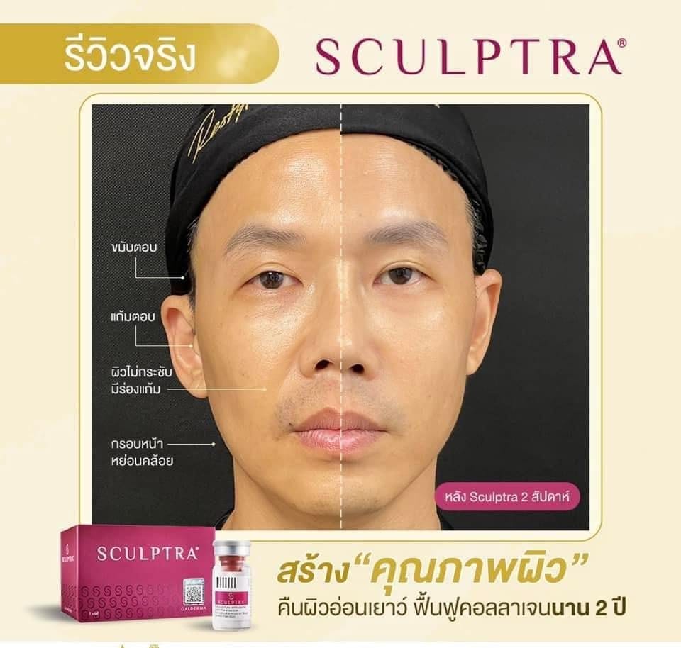 Ai phù hợp và ai không nên tiêm Sculptra?