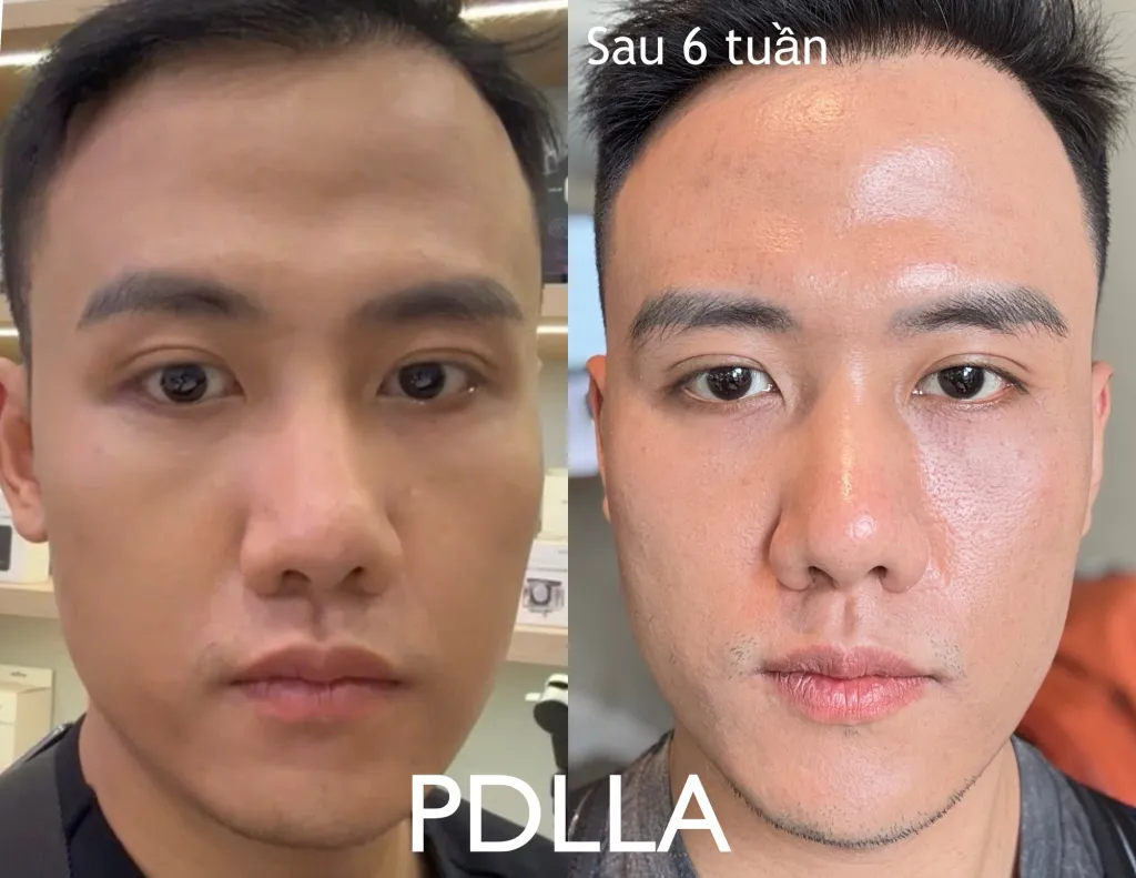 Làm sao để giảm rủi ro khi quyết định tiêm Sculptra — tiêu chí chọn nơi và bác sĩ?