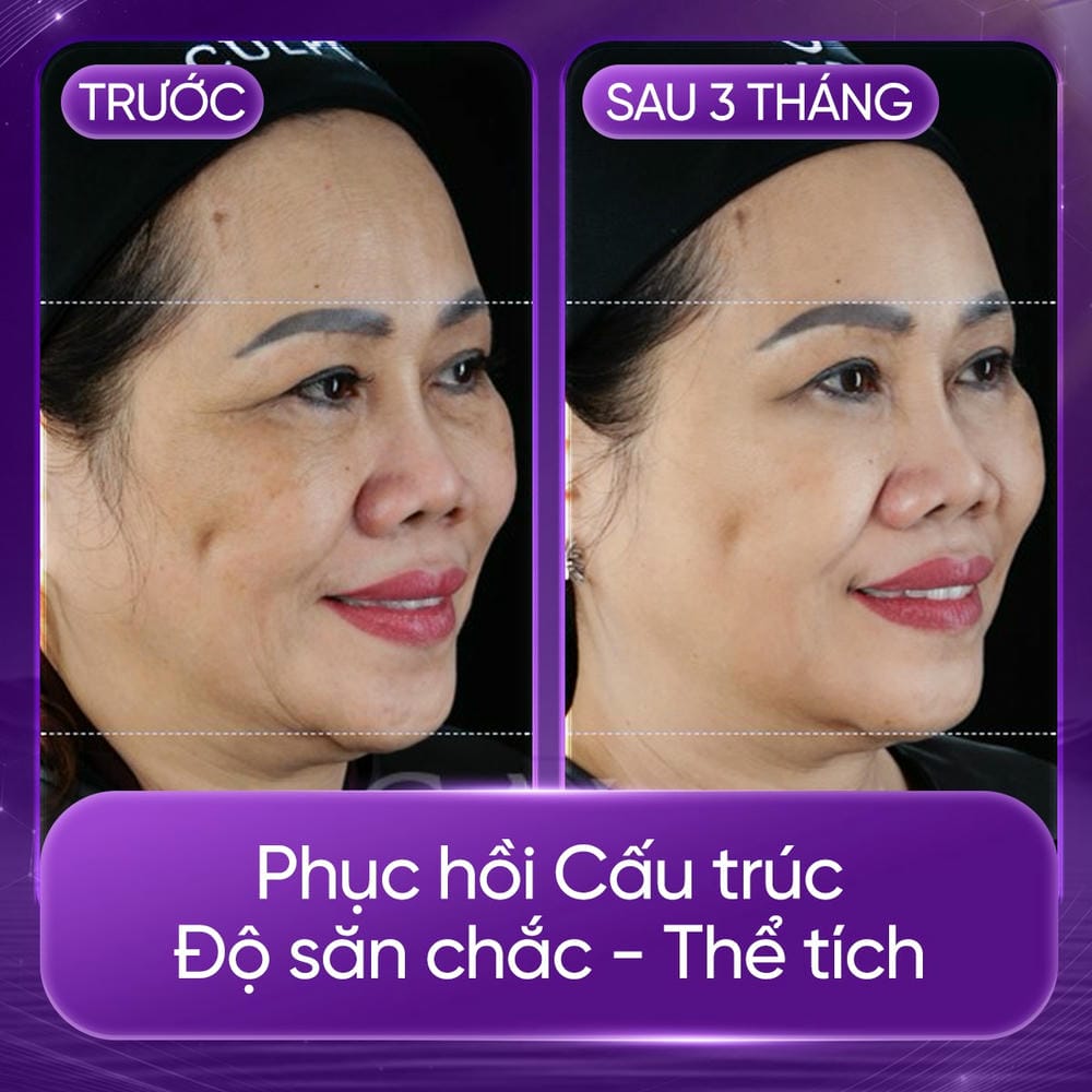 Sculptra so với các filler khác — khi nào nên chọn Sculptra?