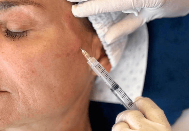 Có thể kết hợp skinbooster với liệu pháp nào để tối ưu?