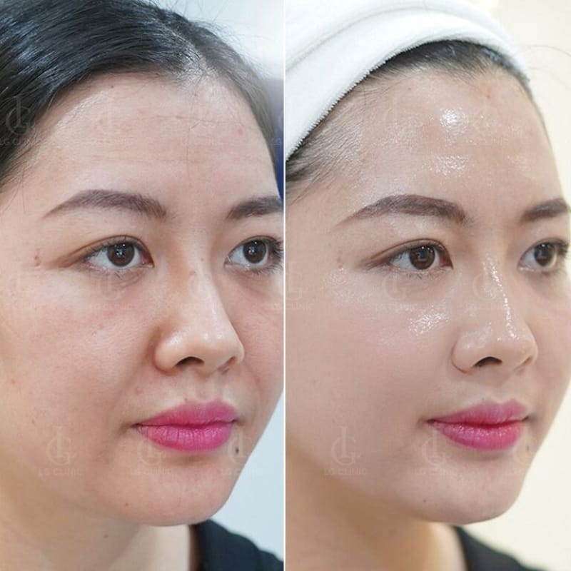 Chi phí tiêm skinbooster thay đổi ra sao?