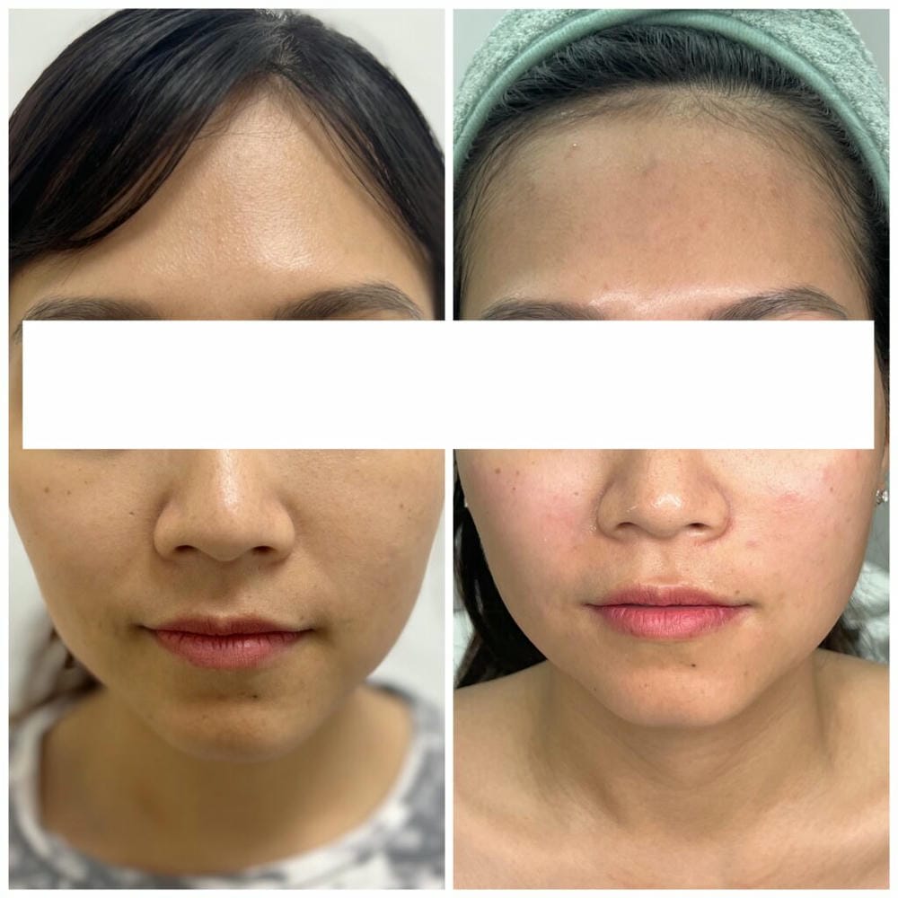 Tiêm Sunekos hoạt động như thế nào — Vì sao lại có tác dụng kéo dài?