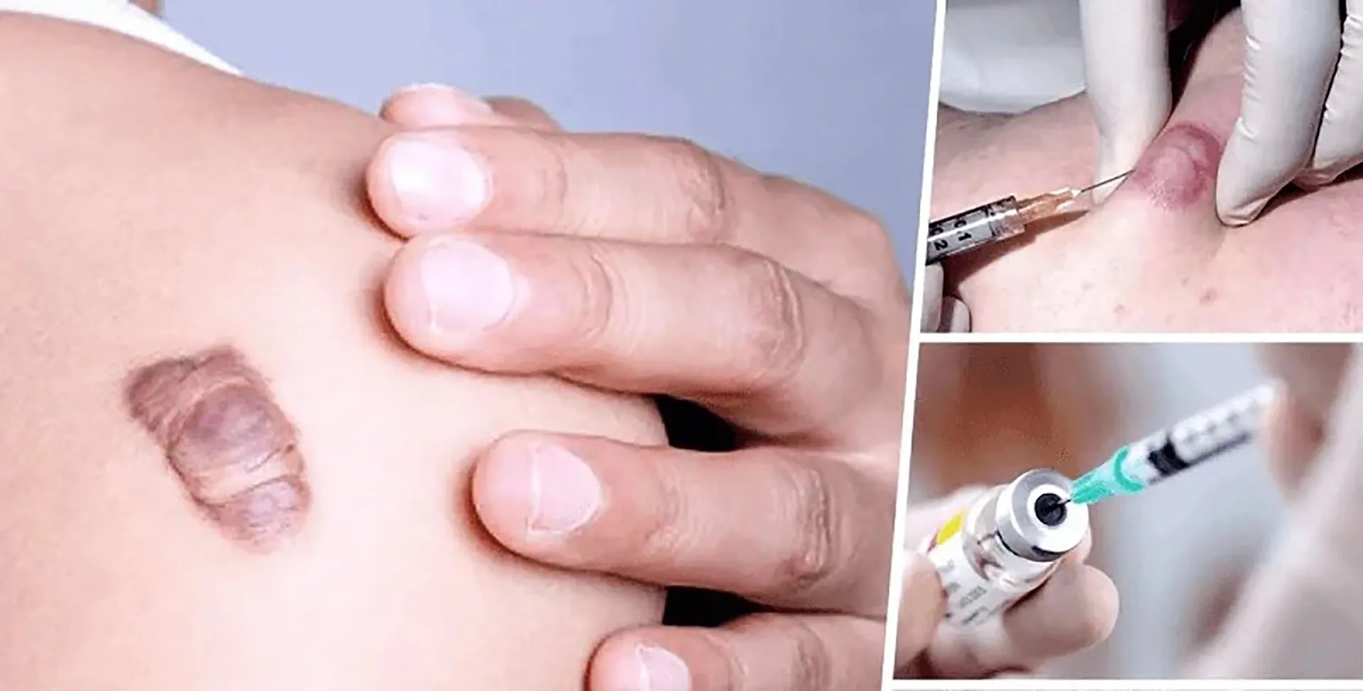 Sẹo lồi sau tiêm có những rủi ro gì, và cách giảm thiểu?