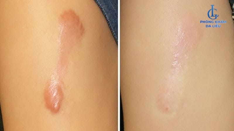 Chăm sóc sau tiêm: cần làm và không nên làm gì?