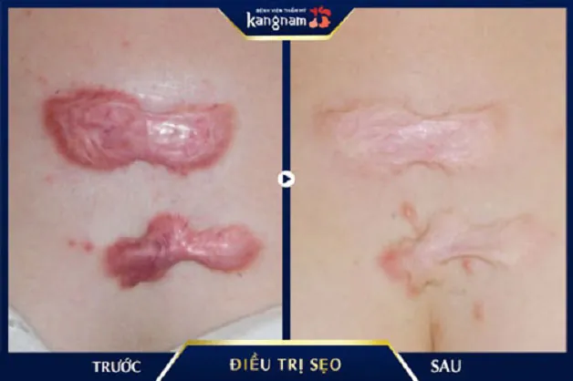 Chăm sóc sau tiêm sẹo lồi: lưu ý để tối đa hiệu quả và giảm tái phát