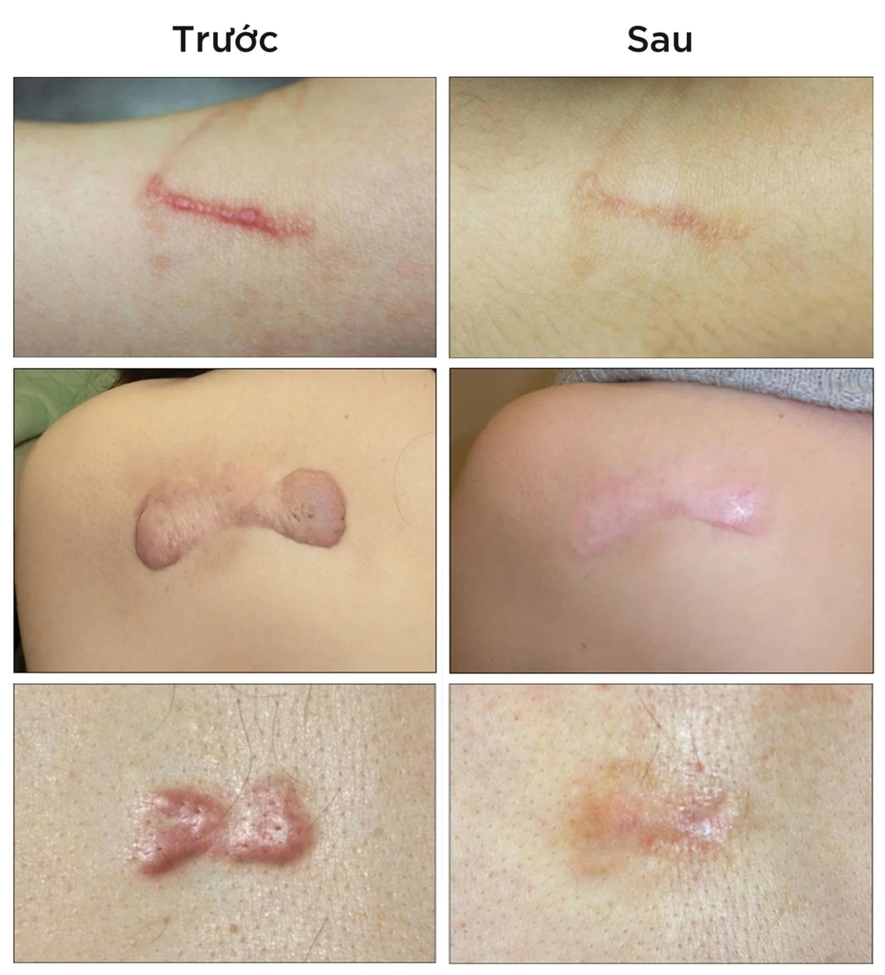 Bằng chứng lâm sàng và nghiên cứu — hiệu quả thực tế của tiêm triamcinolone và phác đồ phối hợp