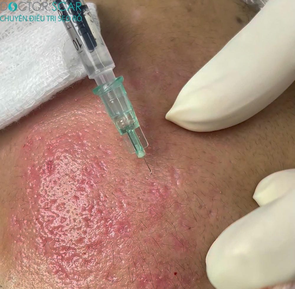 Nên tiêm sẹo rỗ một mình hay kết hợp subcision, laser fractional CO2, RF microneedling?