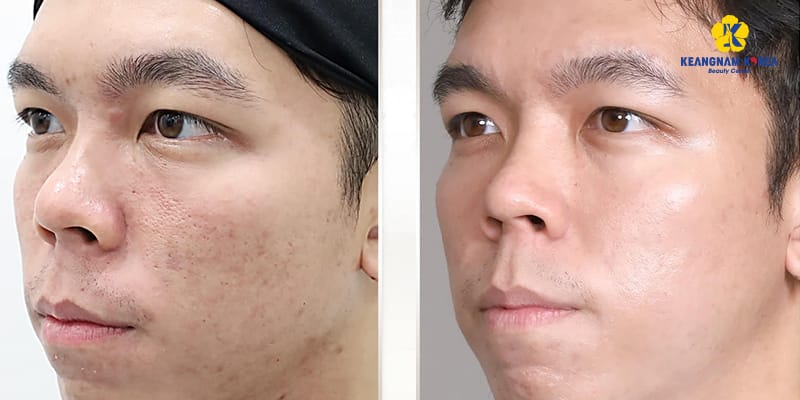 Các lựa chọn thay thế hoặc bổ trợ thường dùng: