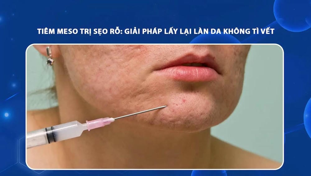 Quy trình tiêm sẹo rỗ an toàn — trước, trong và sau thủ thuật cần chuẩn bị gì?