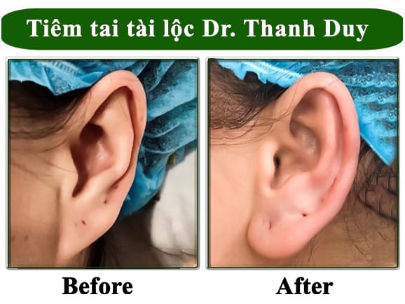 Các loại chất thường dùng cho dái tai
