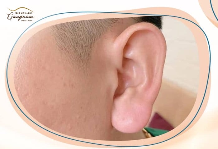 Vậy tiêm tai tài lộc được bao lâu — khoảng thời gian thực tế là bao nhiêu?