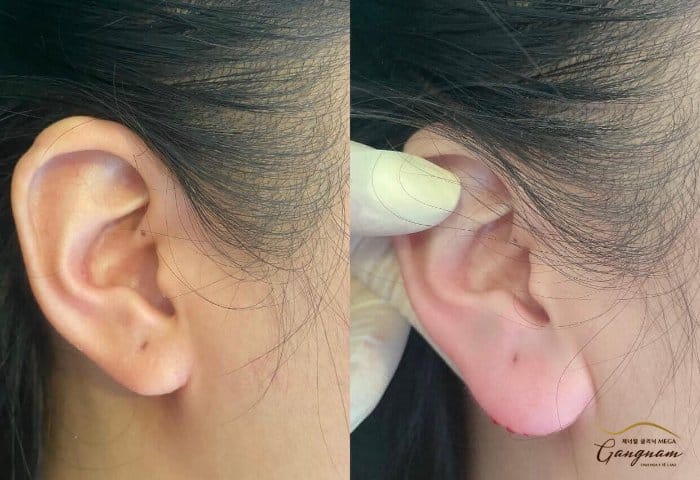 Tiêm tai tài lộc có nguy cơ gì và làm sao để giảm rủi ro?