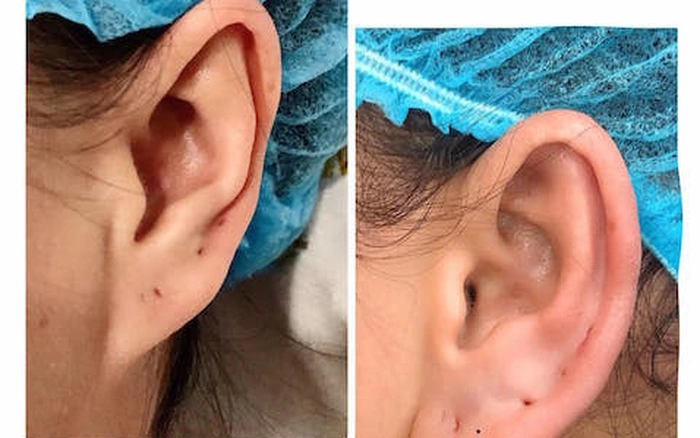 Ai nên và không nên thực hiện tiêm tai tài lộc?