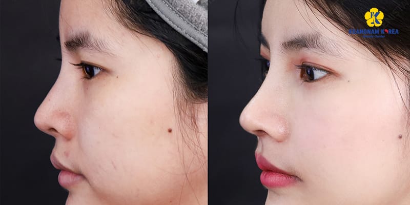Tiêm tan filler bao lâu thì nâng mũi được? Các khuyến nghị thời gian thực tế