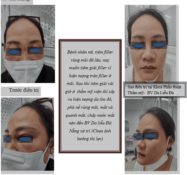 Làm thế nào để phân biệt filler HA và filler vĩnh viễn trước khi tan?