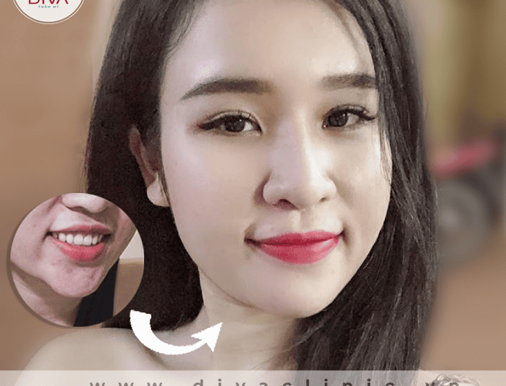 Kết thúc: quyết định nên tan filler hay chờ đợi — làm thế nào để an toàn?