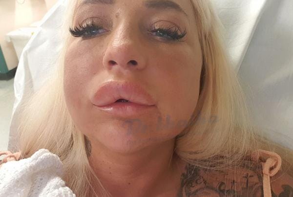 Tiêm tan filler có thể gây biến chứng nghiêm trọng không — những rủi ro cần biết?
