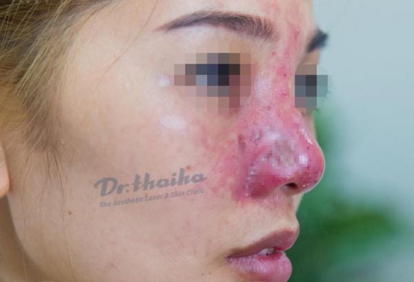 So sánh: tiêm tan filler với chờ tự tiêu — phương án nào an toàn hơn?