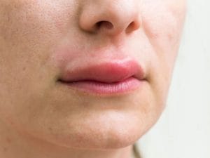 Một vài lưu ý kỹ thuật ảnh hưởng đến sưng