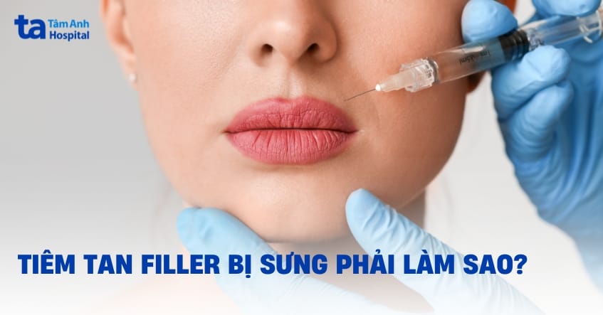 Lời khuyên thực tế trước khi quyết định tiêm tan filler