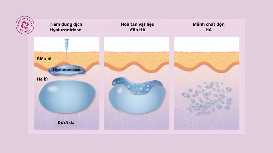 Rủi ro và cách xử trí biến chứng tiêm filler