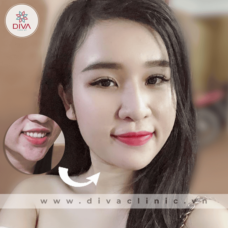 Đã tiêm filler ở nơi khác có an toàn khi tiêm tan?