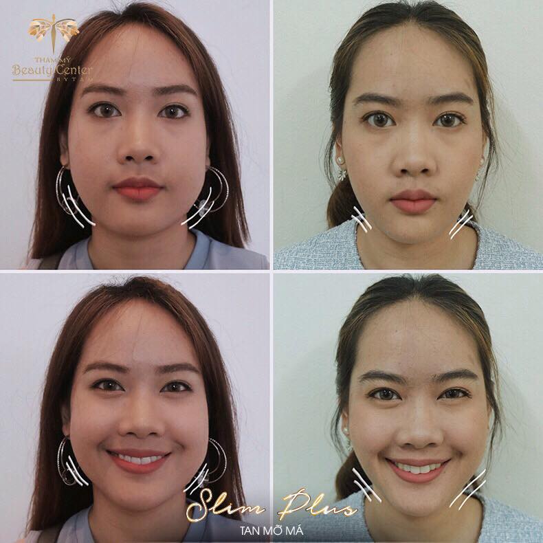 So sánh nhanh các lựa chọn phổ biến để làm mặt thon gọn