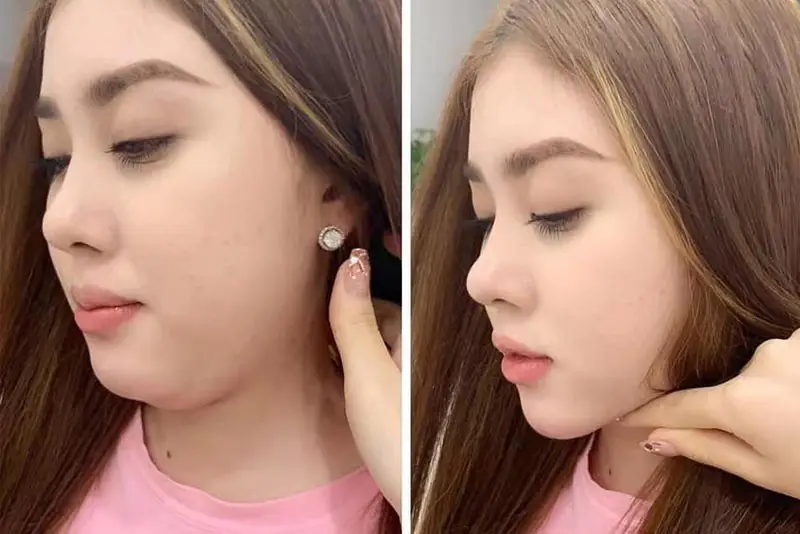 Trước khi tiêm