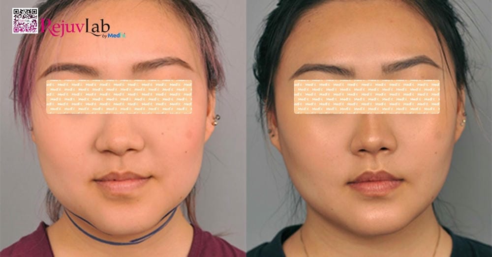 Bằng chứng lâm sàng và giới hạn hiện tại