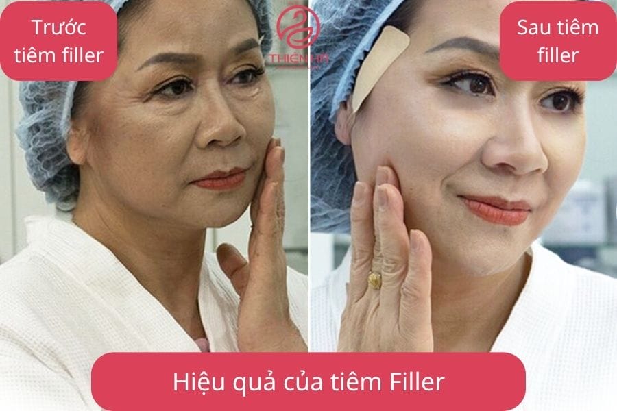 Bảng so sánh Teoxane và filler HA phổ biến