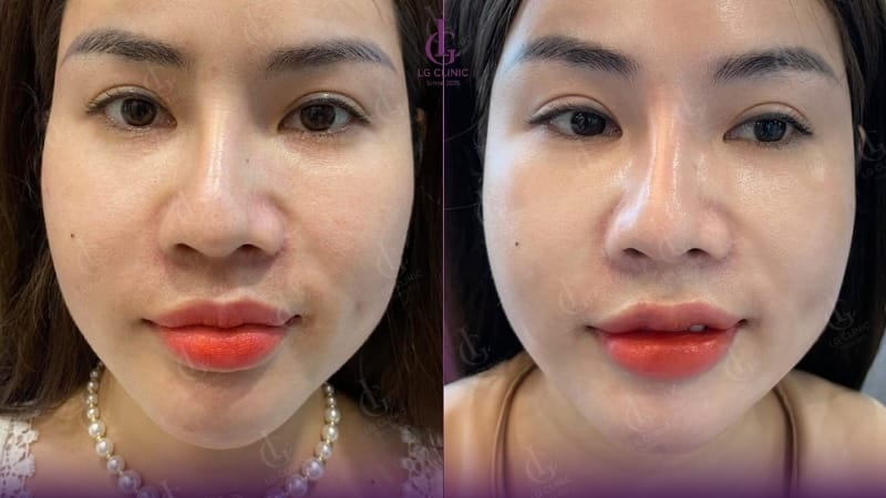 Tiêm Teoxane có thấy hiệu quả ngay lập tức không?