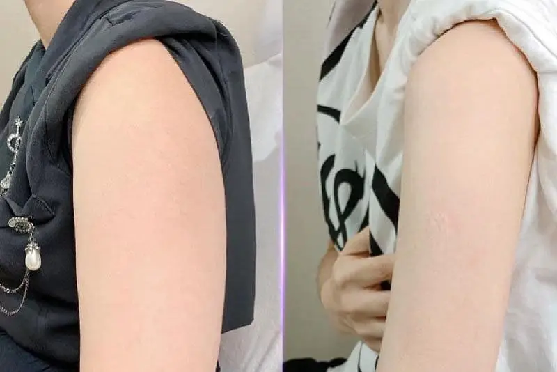 Tiêm thon gọn bắp tay có an toàn không? Biến chứng tiêm thẩm mỹ và tác dụng phụ thường gặp
