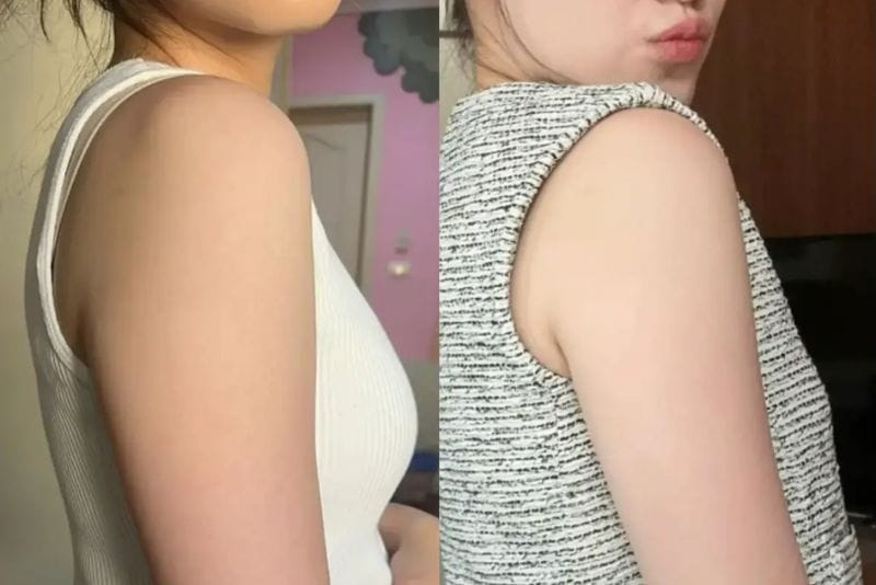 So sánh tiêm botox bắp tay, tiêm tan mỡ bắp tay với hút mỡ, RF, HIFU hoặc tập luyện