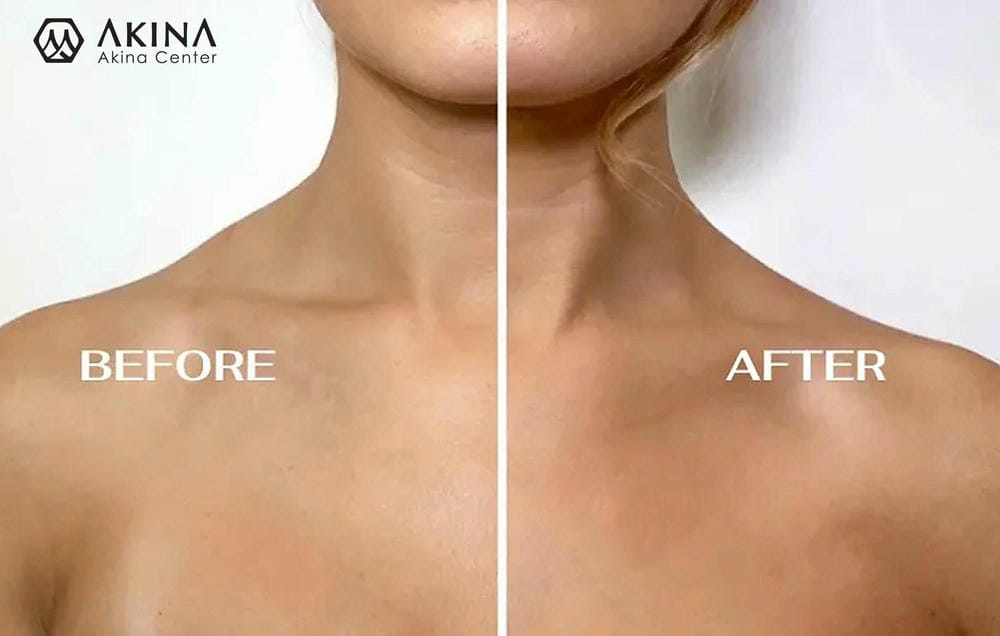 Tiêm thon gọn vai so với các phương pháp khác — chọn phương án nào?
