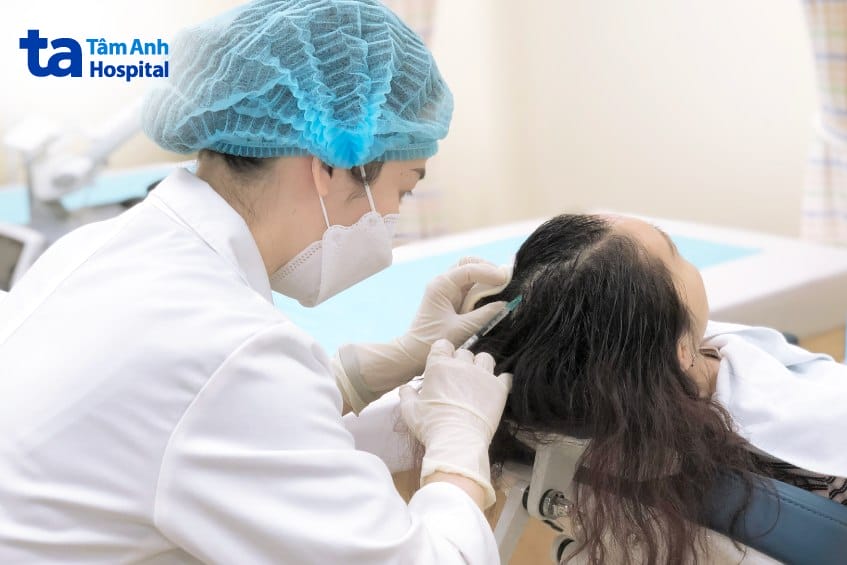 Mesotherapy da đầu (tiêm vi điểm dưỡng chất)