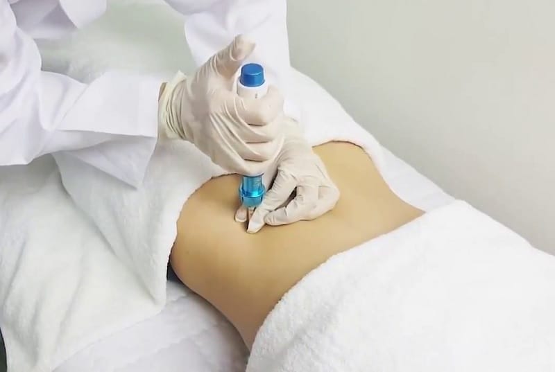 So sánh với hút mỡ (liposuction)
