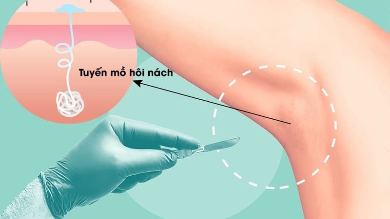 Tiêm triệt tuyến mồ hôi nách có thực sự hiệu quả không — hiệu quả tiêm botox nách kéo dài bao lâu?