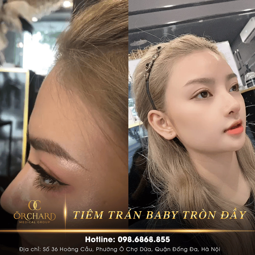 So sánh nhanh: khi nào chọn filler, khi nào chỉ chọn baby Botox?
