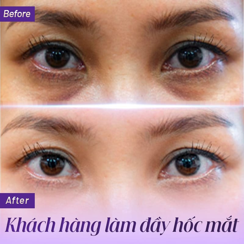 Nguy cơ, tác dụng phụ và ai không phù hợp tiêm trũng mắt?