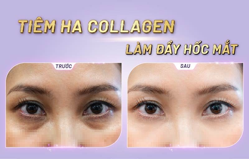 Các phương pháp phối hợp để có kết quả trẻ hóa vùng mắt tốt hơn?