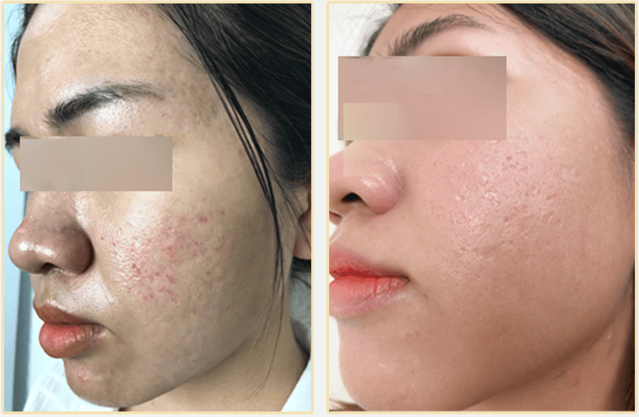 Tiêm trị sẹo rỗ là gì — Chỉ tiêm có đủ hay cần kích thích collagen?