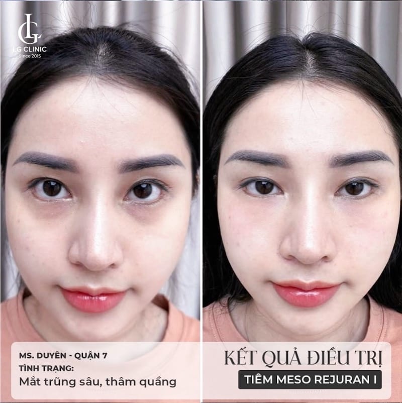 Rủi ro khi tiêm filler vùng mắt