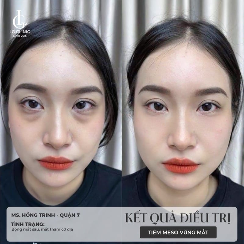 Bảo hiểm kỳ vọng — hiệu quả thực tế và thời gian