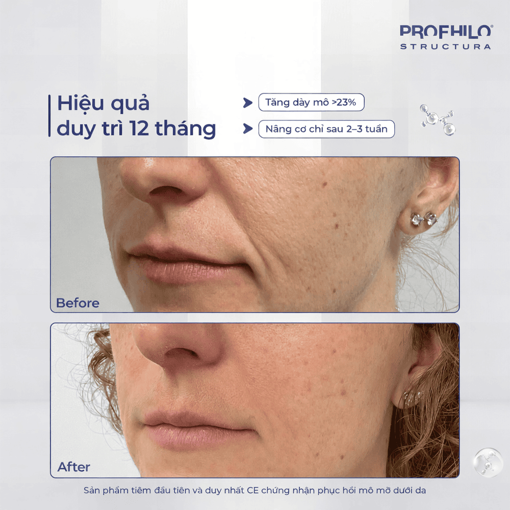 So sánh với filler và cấy mỡ: hiệu quả & hồi phục