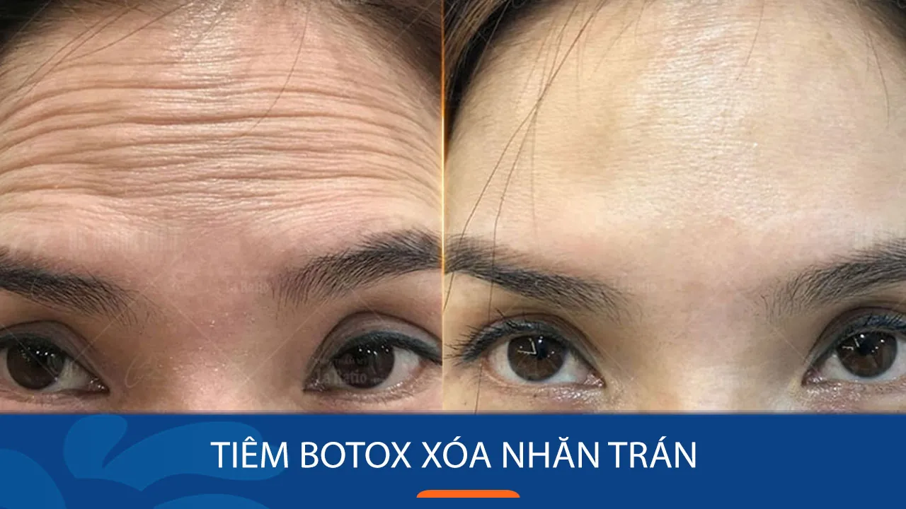 Botox, Dysport, Xeomin — có khác nhau không?