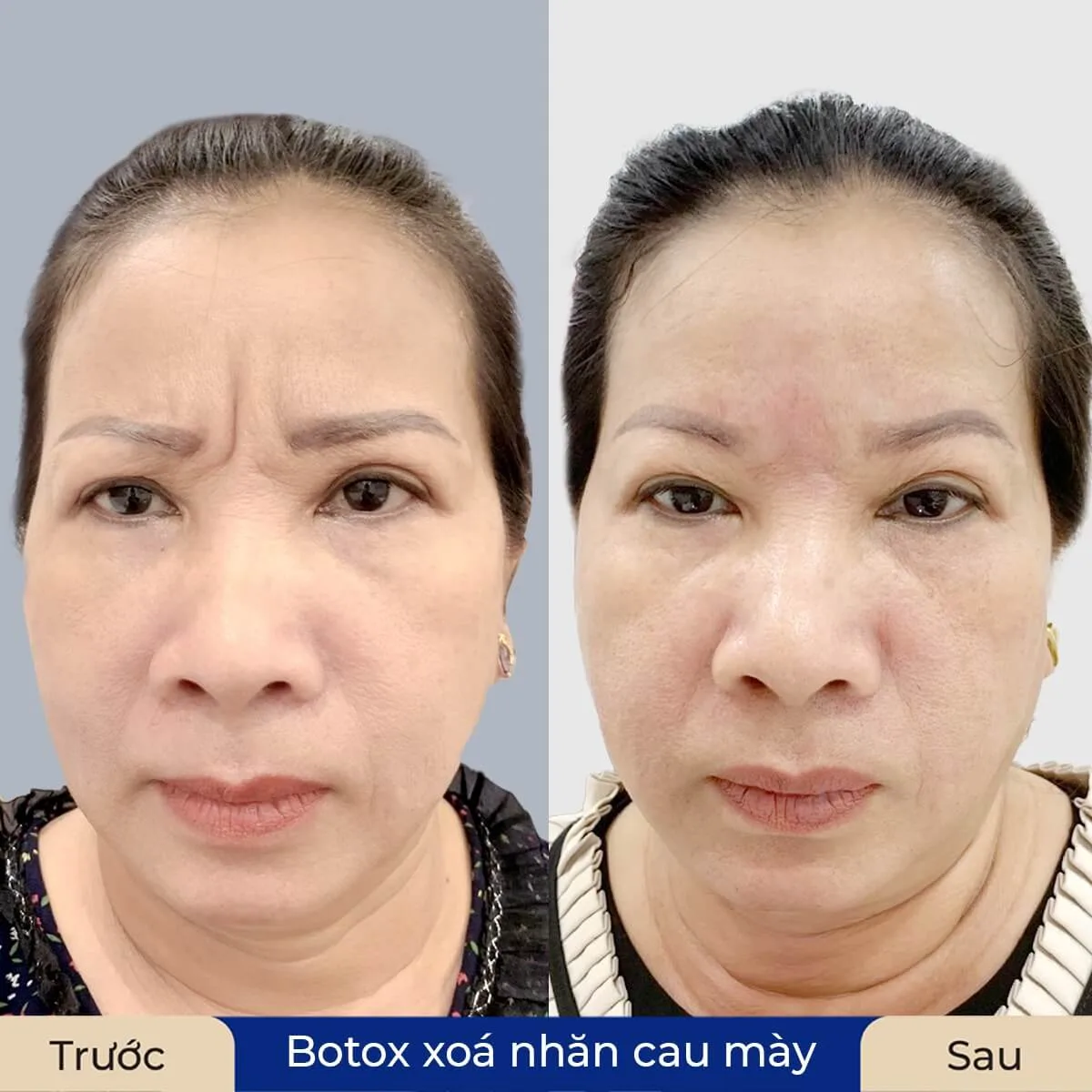 Chăm sóc sau tiêm: những lưu ý để đạt kết quả tốt và giảm biến chứng