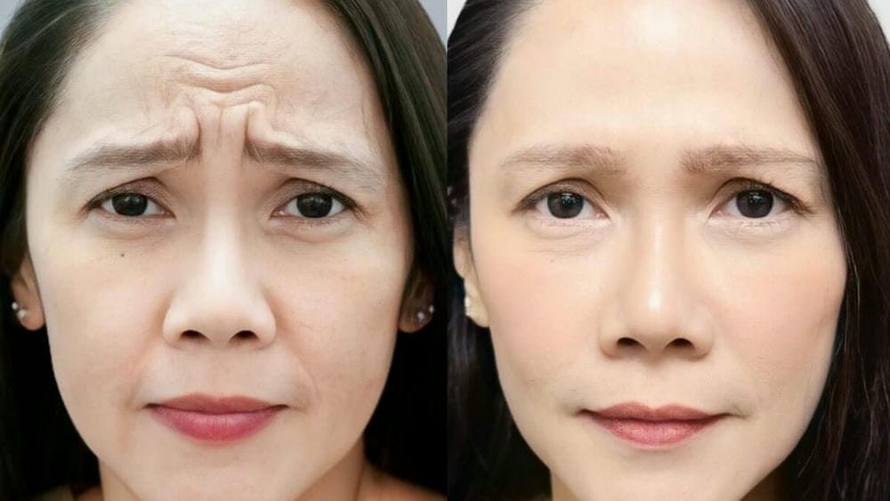 Hiệu quả kéo dài bao lâu và khi nào nên chích lại?
