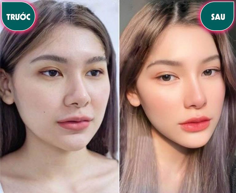 Các loại filler và Botox nào đã có mặt hoặc nên ưu tiên khi tiêm tại Việt Nam?