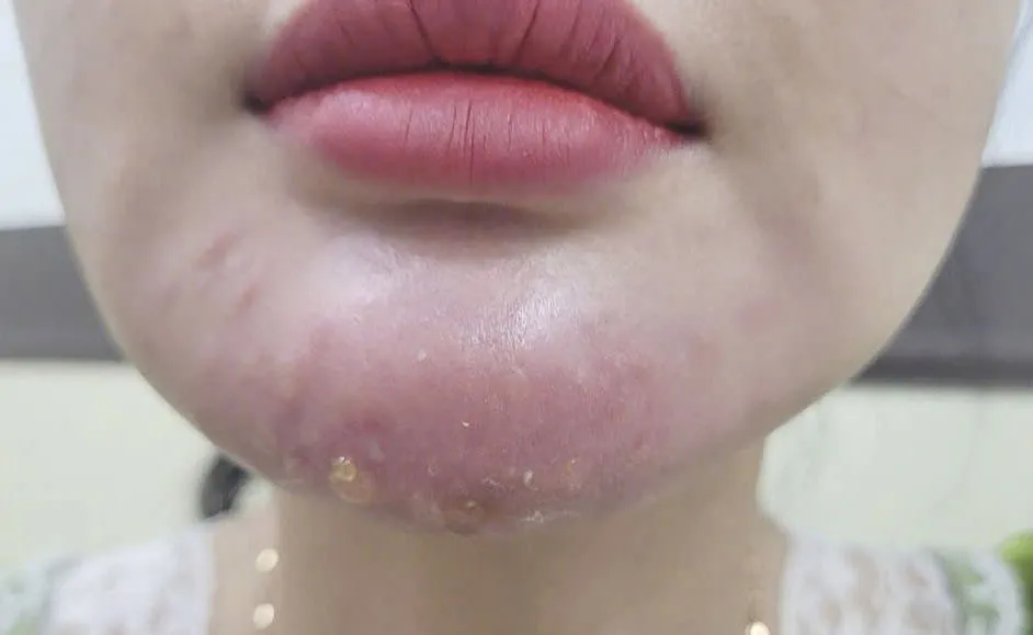 Nếu xuất hiện cục lồi, u hạt hoặc phản ứng muộn thì có những lựa chọn điều trị nào?